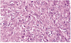 Figure 3.  Pathology: invasion to myometrium