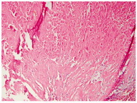 Figure 4.  Pathology: invasion to the bladder