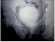 Figure 1. Micturating cystourethrogram of the patient showing dilated posterior urethra