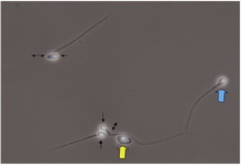 Figure 1. Photomicrographs of the sample with phase contrast microscopy, in which spermatozoa with a round head (arrow), wide (blue arrow) and broken neck (double arrow) are observed. Also, the picture depicts the spermatozoa with dag defect (yellow arrow)