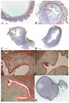 Figure 3. 

A: Complete lumen obstruction of curettage site of uterus induced hydrometra in two uteri (hematoxylin and eosin). 

B: Intact and 

C: Ovariectomized groups’ endometrial damage in the site of curettage (hematoxylin and eosin). 

D: Control ovariectomized group uterine horn section (hemato-xylin and eosin). 

E: Endometrial section of ovariectomized curettage group (Masson’s trichrome). 

F: Endometrial section of intact curettage group (Masson’s trichrome). 

G: Endometrial section of intact control group (Masson’s trichrome). 

H: Presence of corpus lutea in ovarian section of intact group (hematoxylin and eosin)