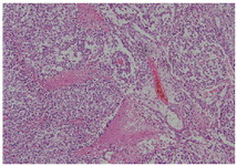 Figure 1. Pathology report, embryonal carcinoma component of the ovarian germ cell tumor 