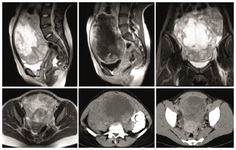 Figure 3. CT and MR images show a huge pelvic mass, just anterior to the uterus, with upward extension to the abdomen. The mass is solid and enhancing at periphery, and centrally necrotic zone. Uterus is obviously separated from the mass on sagittal MR images, favoring non uterine lesion. Right ovary is evident, but left ovary is obscured, suggesting left ovarian origin. Mild ascites is also seen