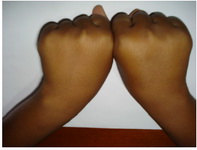 Figure 1. Depressed 4th and 5th finger knuckles in the clenching fist position