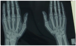 Figure 2. Shortening of metacarpals IV and V