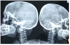 Figure 3. X Ray of the skull showing normal pituitary fossa