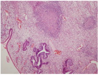 Figure 1. H&amp;E, 4X-Section showing endocervical epithelium with epitheloid granuloma in the stroma
