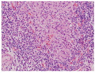 Figure 2. H&amp;E, 20x Epitheloid granuloma with langerhans giant cells