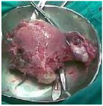 Figure 2. &nbsp;Enlarged uterus, ovarian metastasis, perforation of uterus, and myometrium invasion