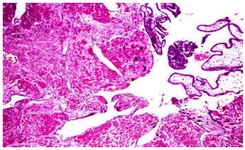 Figure 3. Villous formation in myometrium