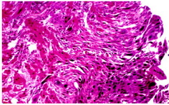 Figure 4. Villosity with necrosis in invasive mole