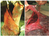 Figure 1. Peeling chorionic and amniotic membranes from each other in a placenta