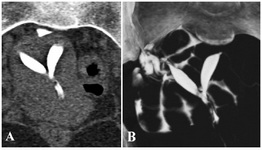 Figure 1. A: MPR coronal image shows incomplete uterine septum separating the two spindle shaped cavities, uterine fundal contour appears normal. B: MIP image showing septate uterus