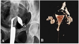 Figure 2. A: Abnormal uterine position on HSG shows a spindle shaped uterine cavity deviated towards left with patent left fallopian tube. Right fallopian tube is not seen. Findings are suggestive of a unicornuate uterus on HSG. B:VRT image from MDCT-HSG shows a normal uterine cavity, right terminal hydrosalpinx with fimbrial block, left fallopian tube is patent. However, non-filling of right tube led to the misinterpretation of a unicornuate uterus on HSG