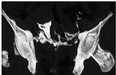 Figure 3. MIP image from a patient shows evidence of linear filling defect within the contrast filled uterine cavity suggestive of intrauterine adhesion
