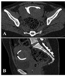 Figure 4. A: Axial and&nbsp; figure B: Sagittal MPR image show a large broad based postero-lateral filling defect within the contrast filled uterine cavity suggestive of a submucosal leiomyoma

