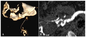 Figure 6. A: VRT shows normal uterus with patent right fallopian tube with peritubal spill and left tubal block; B: Curved MPR excellently unfolds the convoluted right fallopian tube which shows evidence of beading and irregular outline suggestive of salpingitis. Right ovary is seen as an ovoid filling defect within the spilt contrast.
