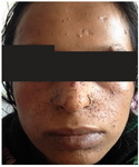 Figure 1. Picture showing adenoma sebaceum