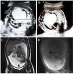 Figure 2. A 23 year old primi of tuberous sclerosis with live intrauterine fetus at 26 weeks of gestation showing cardiac rhabdomyoma. A: Ultrasound in ventricular diastole showing an echogenic mass (M) arising from the wall of the left ventricle (LV), note the pericardial effusion (PE), normal right ventricle (RV) and interventricular septum (IVS). B: Ultrasound showing the ventricle (V) in systole. C: MRI -T2WI showing an isointense mass (M) arising from the left ventricle. D: MRI with fat suppression, note that the mass (M) shows no visible fat suppression