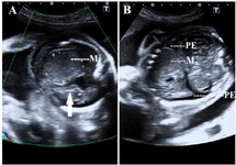 Figure 3. A 23 year old primi of tuberous sclerosis with fetal cardiac rhabdomyoma at 31 weeks of gestation resulting in IUFD. A: Color Doppler ultrasound showing absent cardiac activity (arrow), note the mass (M) and subcutaneous edema. B: Ultrasound in coronal section showing the mass (M) arising from the left ventricle, note the bilateral pleural effusion (PE)