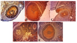Figure 3. Photo micrographs of immunohistochemical ex-pression of TNF-&alpha; in infolded layers and follicular fluid of Graafian follicles and cysts. A) Due to high levels of angio-genesis, the density of follicular fluid, as well as TNF-&alpha; ex-pression are high. The thick theca and granulosa layers in-dicate high expression levels of TNF-&alpha; in PCOS group. B, C, D, F) decreased TNF-&alpha; expression levels in follicular fluid and granulosa layer in curcumin groups (100, 200, 300, 400 mg/kgBW), Magnification &times;40, (Scale bar, 20 &mu;m). Granular cell layer (&rarr;), follicular liquid of Graafian follicle (∆)
