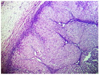 Figure 3. Well circumscribed solid mass of luteinized cells replacing ovarian tissue, seen at the periphery ( H&amp;E, x100)
