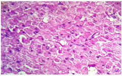 Figure 4. The cells were moderate in size having abundant eosinophilic cytoplasm and central nuclei. Few of these showed prominent nucleoli (H&amp;E, x400)
