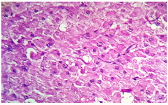 Figure 4. The cells were moderate in size having abundant eosinophilic cytoplasm and central nuclei. Few of these showed prominent nucleoli (H&amp;E, x400)
