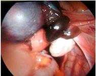 Figure 1. Isolated torsion of the right fallopian tube