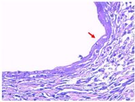 Figure 2. Hematoxylin-eosin (HE) staining of rat surgically-induced endometriosis (40x magnification). HE staining from our previous study proved that endometrial cyst induced with autotransplantation was truly an endometriosis tissue. The red arrow sign indicates the presence of the endometrial gland