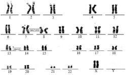 Figure 2. Karyotype analysis in an infertile woman showing a de novo insertion between chromosomes 7 and 13