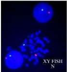 Figure 2. XY FISH image showing one green (X-centro-mere) and one red (Y-centromere) signal in interphase and metaphase cells of patient indicating normal (N) male sex chromosome
