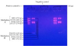Figure 3. Multiplex-STS PCR picture showing no deletion in AZF region in both positive control (left panel) and SCOS case (right panel). No AZF region was present in negative control (middle panel)